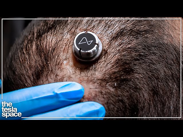Neuralink Begins First Human Experiments!
