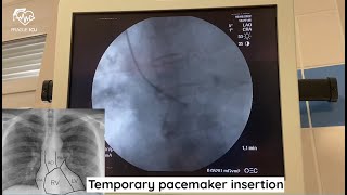 Temporary pacemaker insertion