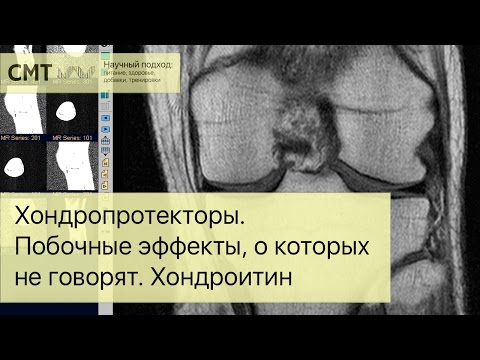 Хондропротекторы. Побочные эффекты, о которых не говорят. Хондроитин и глюкозамин