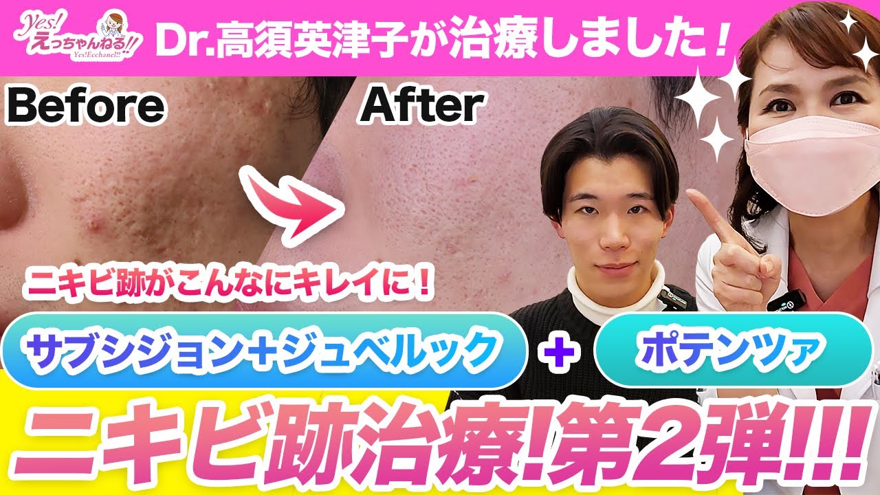 【ニキビ治療第2弾】高須クリニックのニキビ跡治療を紹介します【サブシジョン】【ポテンツァ】