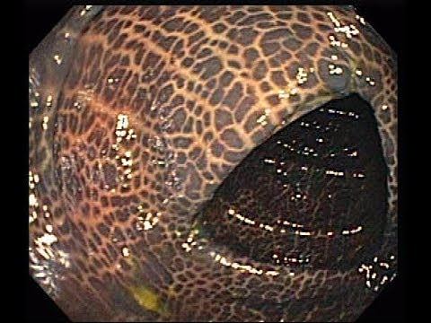Asin-free diyeta sa cellulite Paano sa mawala timbang 7 kg bawat buwan