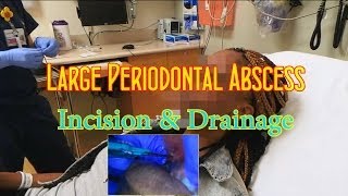 Periodontal Abscess Incision