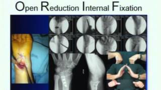 Update: Complex Upper Extremity Fractures