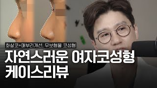 “안 한 티 안 나게 예뻐졌어요” 무보형물 코성형 3개월 경과 | 화살코+매부리+휜코 개선 | 자연스러운 여자코성형