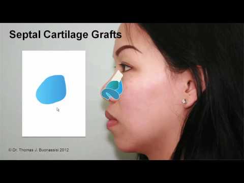 Septal Cartilage Grafts Case Study Part 1 | Asian Rhinoplasty with Dr. Buonassisi in Vancouver BC