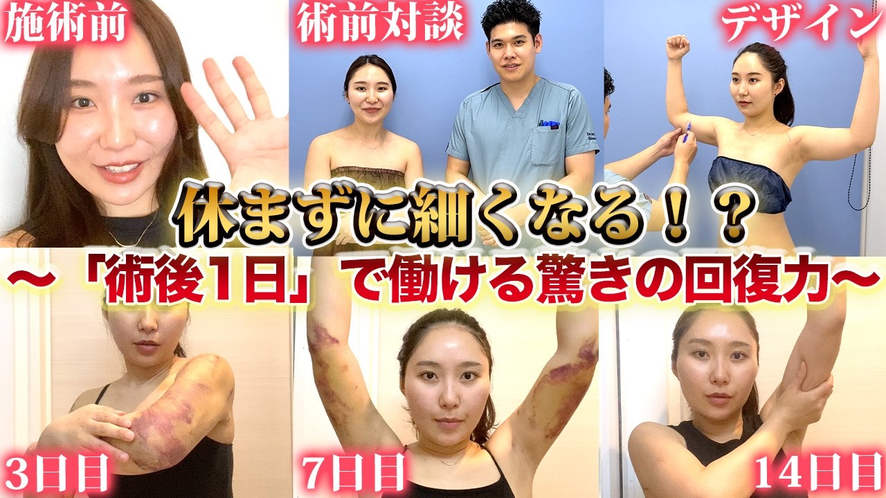 【実録】休まずに二の腕痩せ！術後1日で働ける驚きの回復力と全経過を公開！