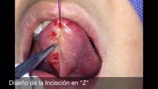 Frenilectomía Lingual en Z