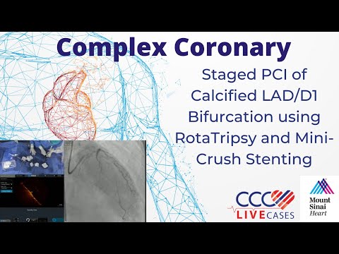 Staged PCI of Calcified LAD/D1 Bifurcation using RotaTripsy and Mini-Crush Stenting