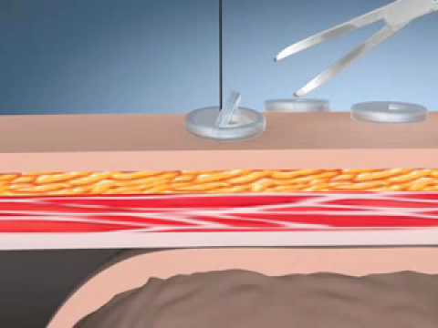 Kimberly-Clark MIC* G Introducer Kits - Endoscopic Placement