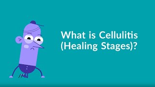 Cellulitis Healing Stages