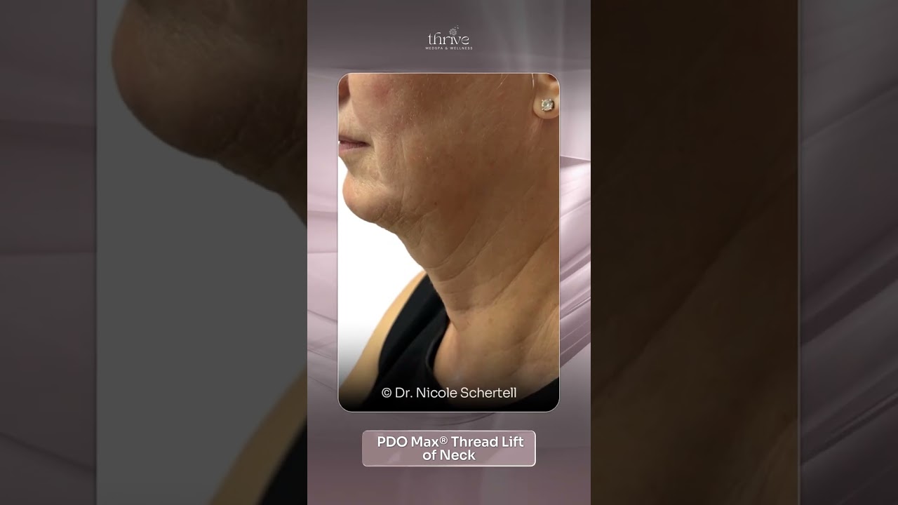 PDO Max® Thread Lift of Neck