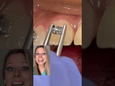 Does it HURT to get BRACES PUT ON? #braces #orthodontics #teeth