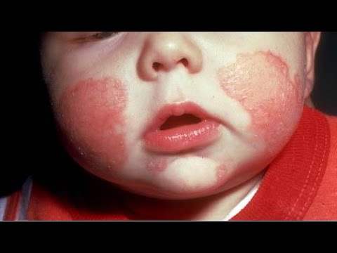 Que no es posible es a atopicheskom la dermatitis a los adultos La psoriasis y las hierbas