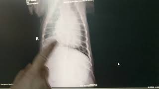 Labrador Retreiver with Primary Lung Cancer Xray and Side effects