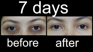 काले घेरों से कैसे छुटकारा पाएं/magical Home Remedies to remove Under eye Dark Circles (Hindi)
