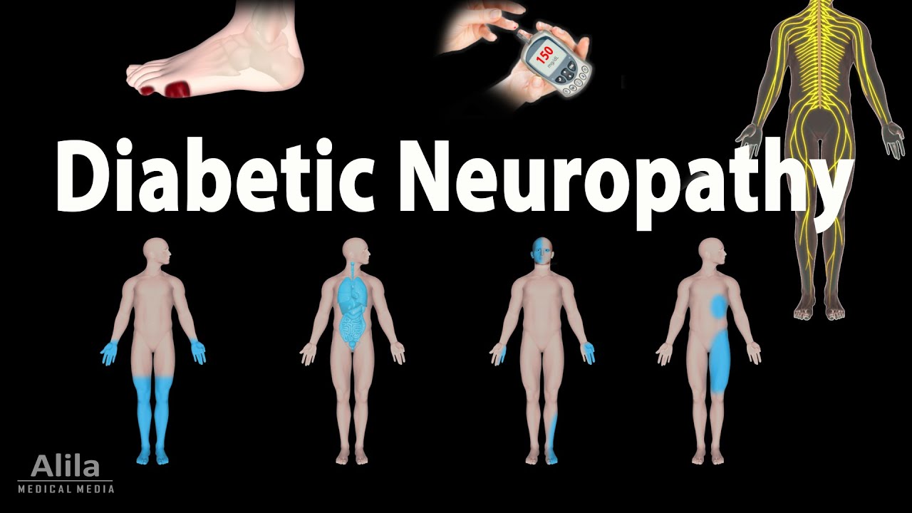 Diabetic Neuropathy, Animation