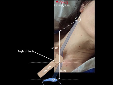 How to Measure the Jugular Venous Pressure (JVP)