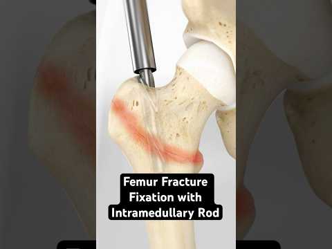 Femur Fracture Fixation with Intramedullary Rod (3D Animation)