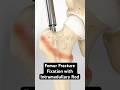 Femur Fracture Fixation with Intramedullary Rod (3D Animation)