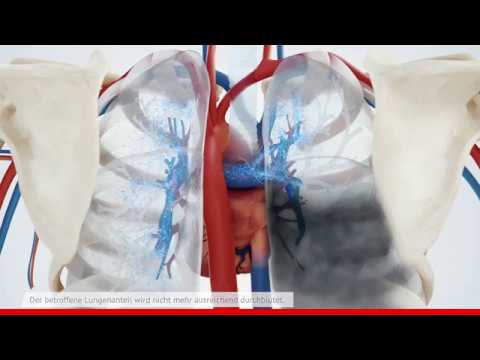 What is a pulmonary embolism?