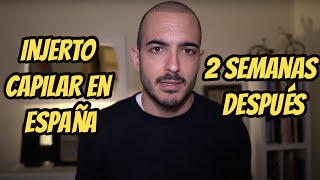 Trasplante capilar en España, dos semanas después