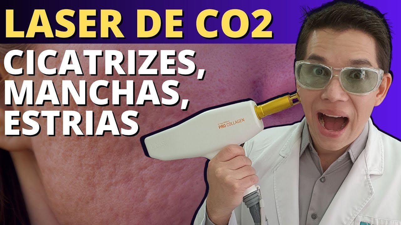 Fractional CO2 Laser: Acne Scars and Skin Rejuvenation