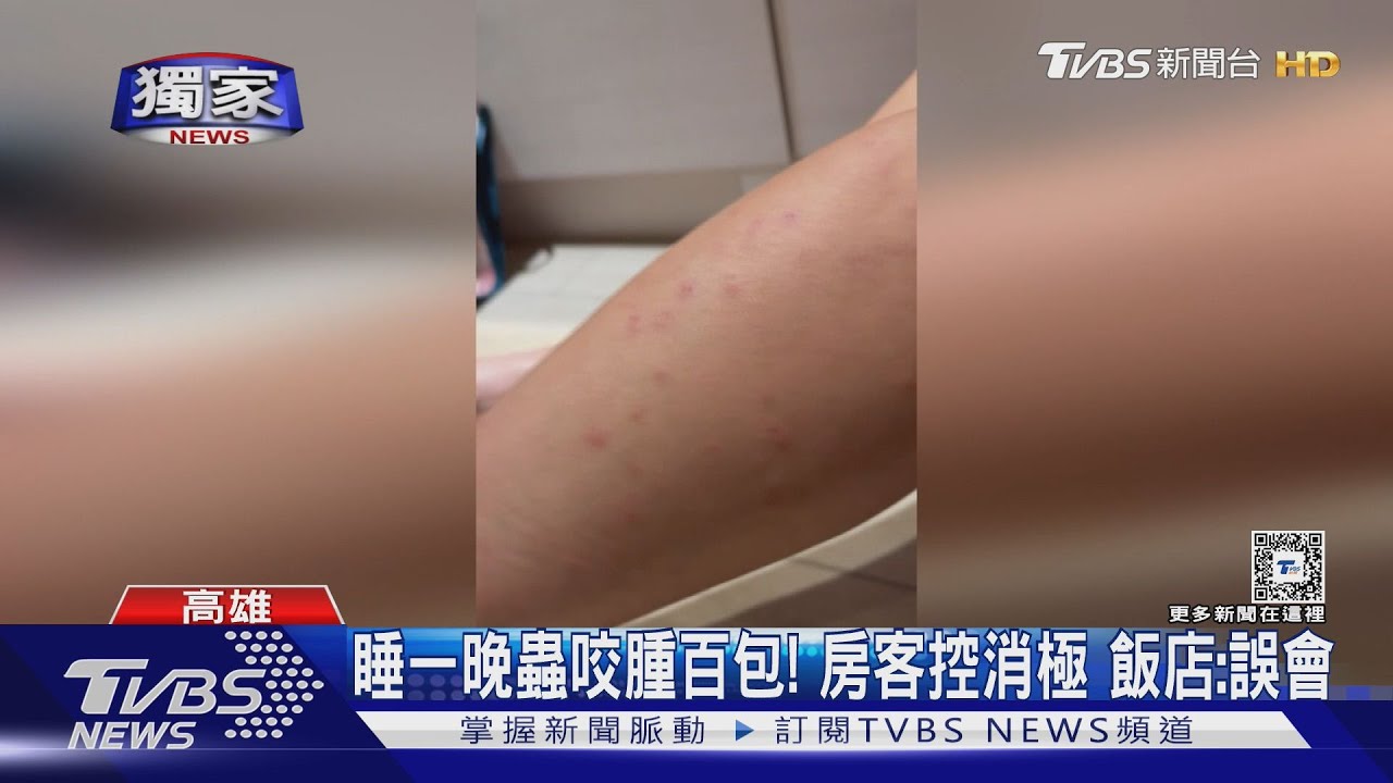 睡一晚蟲咬腫百包!女房客控消極 星級飯店:誤會