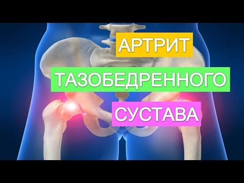 Что такое  артрит тазобедренного  сустава. Симптомы  артрита тазобедренного  сустава.