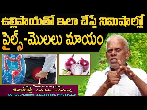 ఉల్లిపాయతో ఇలా చేస్తే పైల్స్ - మొలలు ఇక రానే రావు | Home Remedies For Piles With Onion | Health Tips