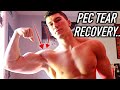 MY PEC TENDON TEAR EXPERIENCE | HOW I CAME BACK