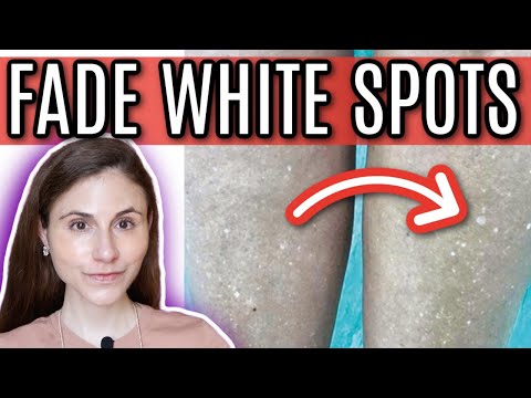 How to FADE WHITE SPOTS from SUN DAMAGE | Dr Dray