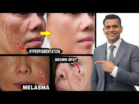 Get Rid Of Hyperpigmentation, Melasma, Brown Spot Naturally - Dr. Vivek Joshi
