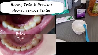 How to Get Rid of Tartar & Plaque | Aerica Lee