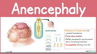 Anencephaly Explained | Neural Tube Defect | Medical and Nursing High-yield Tutorial