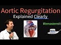 Aortic Regurgitation (Aortic Insufficiency) Explained Clearly - Remastered