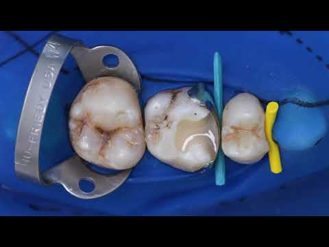 Tetric PowerFill & Tetric PowerFlow | EN | Ivoclar