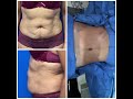 Tummy Tuck Surgery Tummy Tuck Surgery Near Me