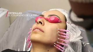 Hilos de Colágeno - Promoestética