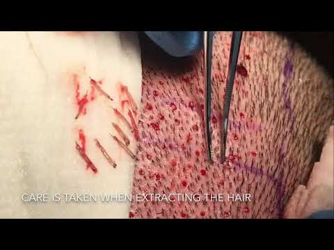 Follicular Unit Extraction (FUE) Hair Transplant by...