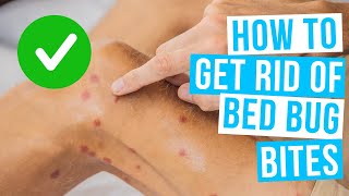 How to GET RID OF BED BUG BITES overnight!