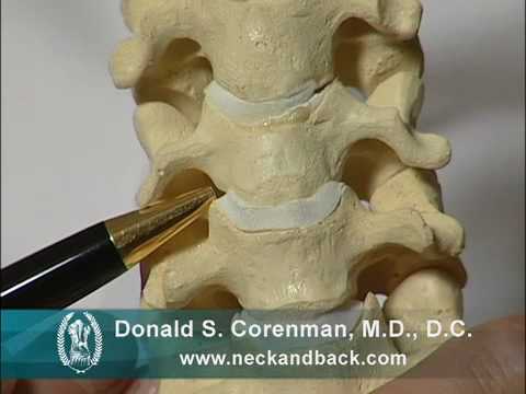 Sténose foraminale cervicale et compression nerveuse