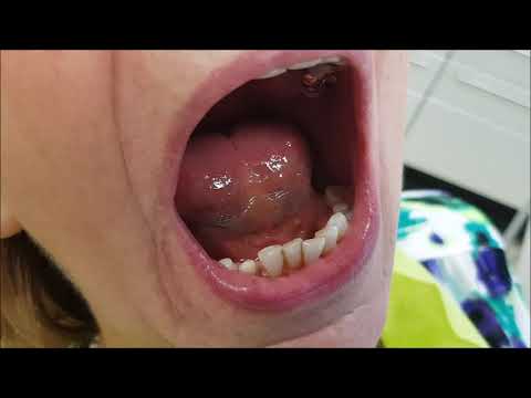 Metal-free telescopic denture made of zirconia and PEEK - suitable for allergy sufferers - Dentis...