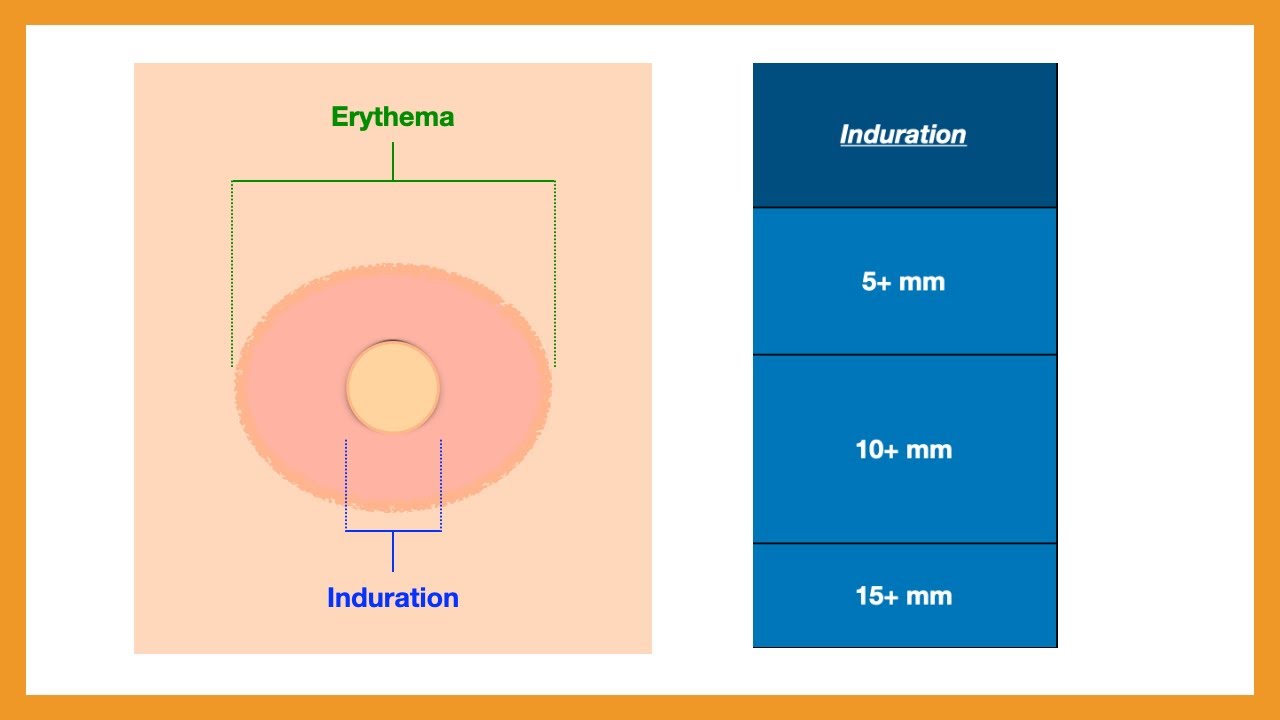 PPD (Tuberculosis) Test Results & Interpretation
