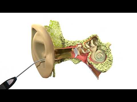 Earwax Microsuction 3D