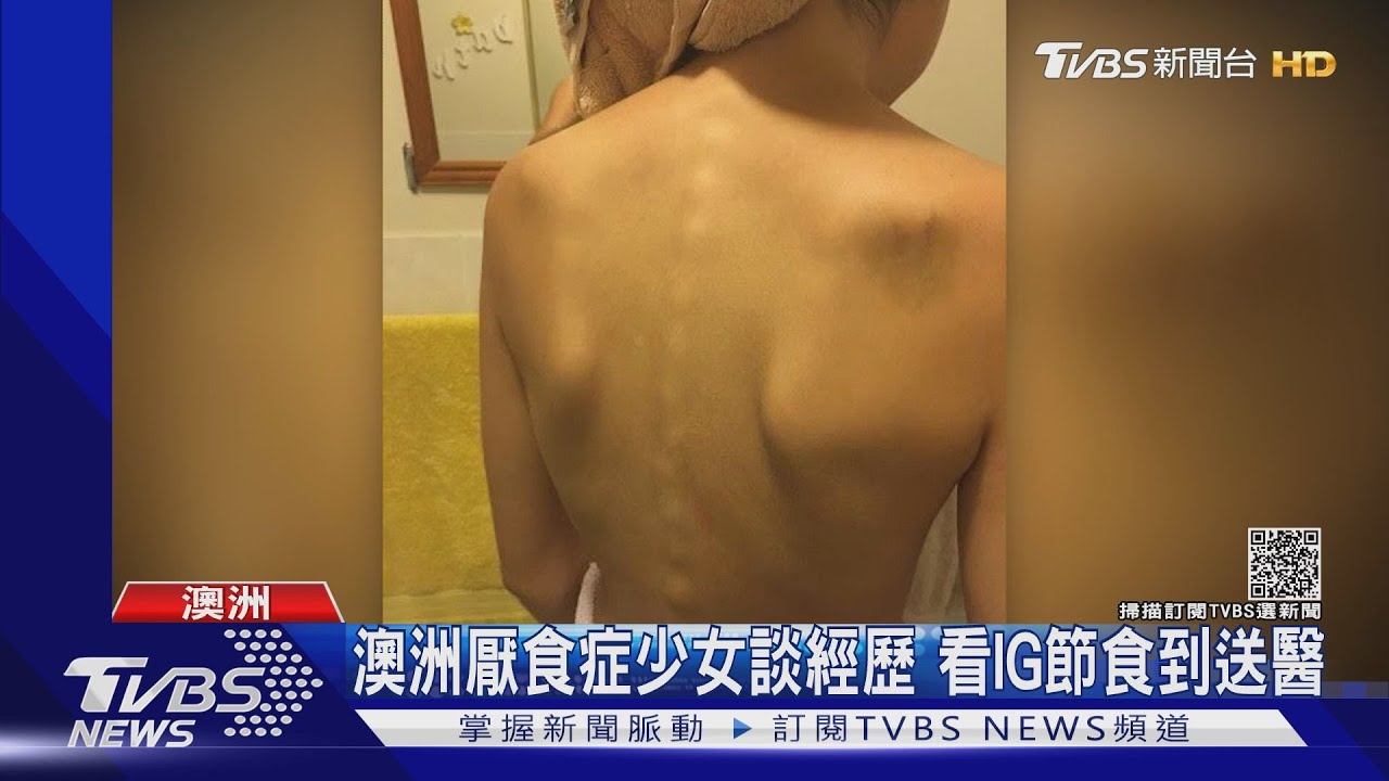 澳洲厭食症少女談親身經歷 看IG上癮節食到送醫