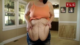 Woman Bravely Shows Sagging Skin After Losing 246 Pounds