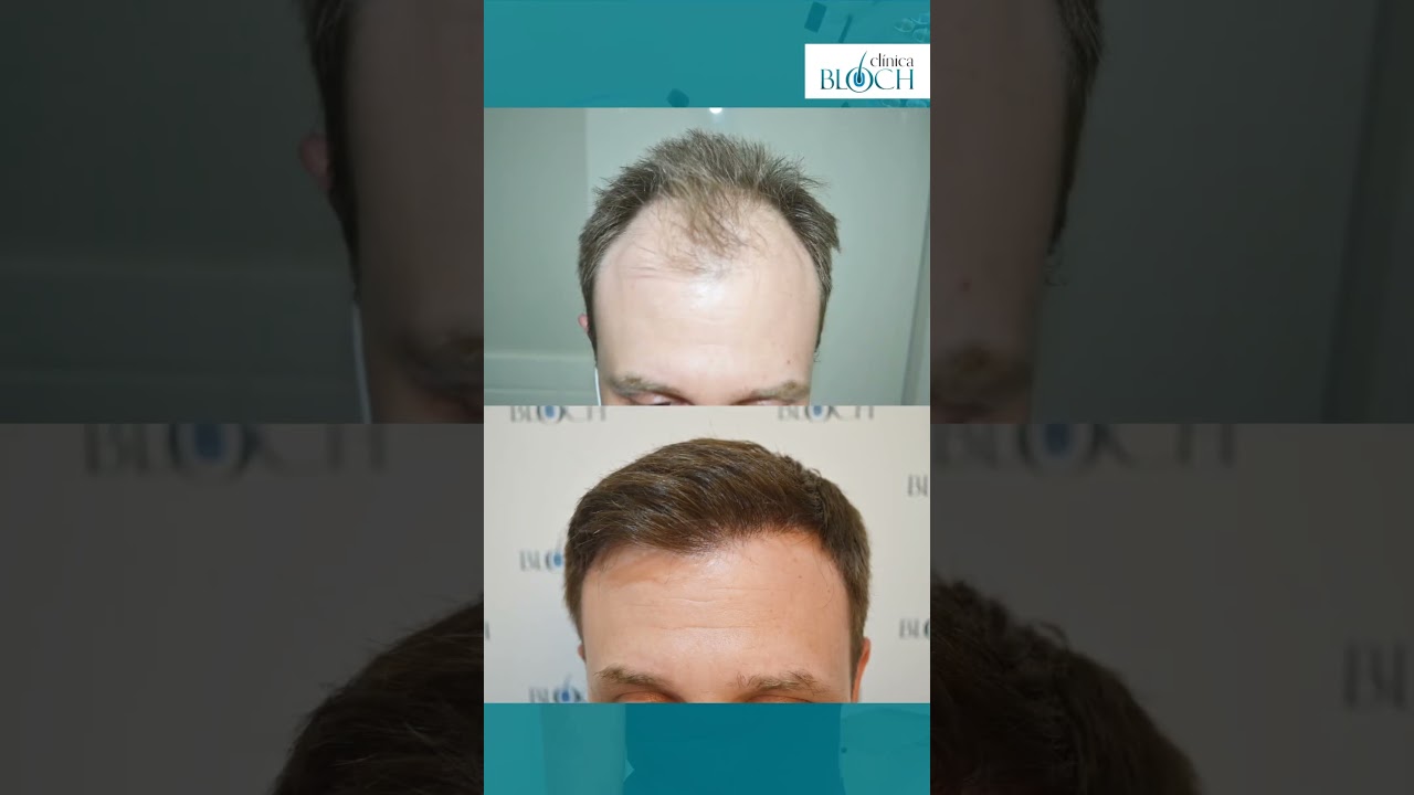 Resultado 1 ano de transplante capilar com Dra. Leila Bloch!