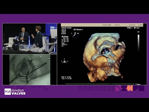 From repair to replacement: portfolio of options for your mitral & tricuspid regurgitation patients