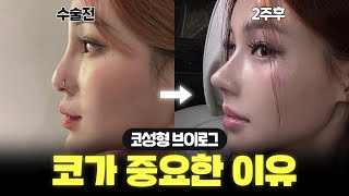 코 하나로 200% 예뻐졌다면 믿어줄래? | 코성형 브이로그