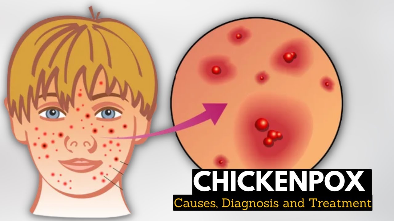Chickenpox Explained In 4 Minutes - Conditions A-Z | HealthReflect.com